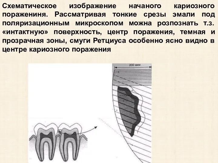 Схематическое изображение начаного кариозного поражениня. Рассматривая тонкие срезы эмали под поляризационным микроскопом