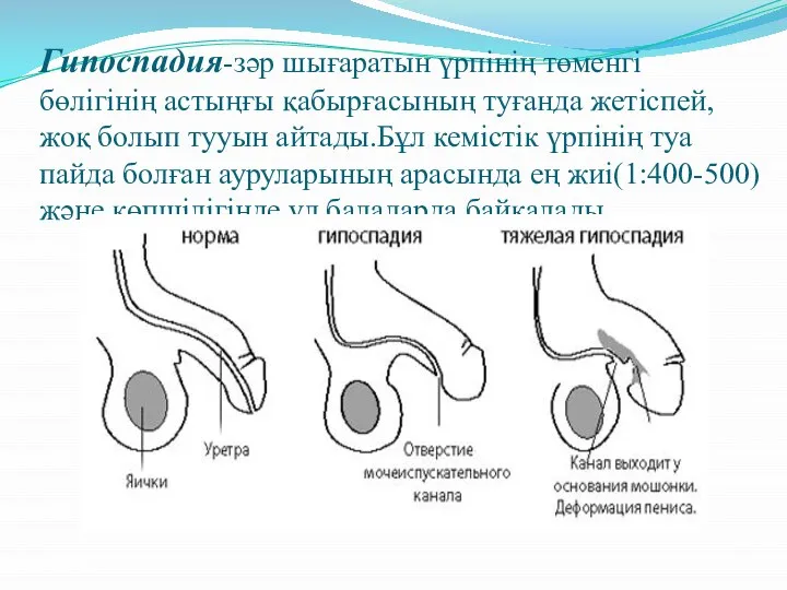 Гипоспадия-зәр шығаратын үрпінің төменгі бөлігінің астыңғы қабырғасының туғанда жетіспей,жоқ болып тууын айтады.Бұл