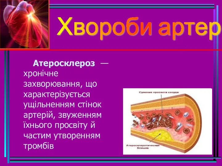 Хвороби артерій Атеросклероз — хронічне захворювання, що характерізується ущільненням стінок артерій, звуженням