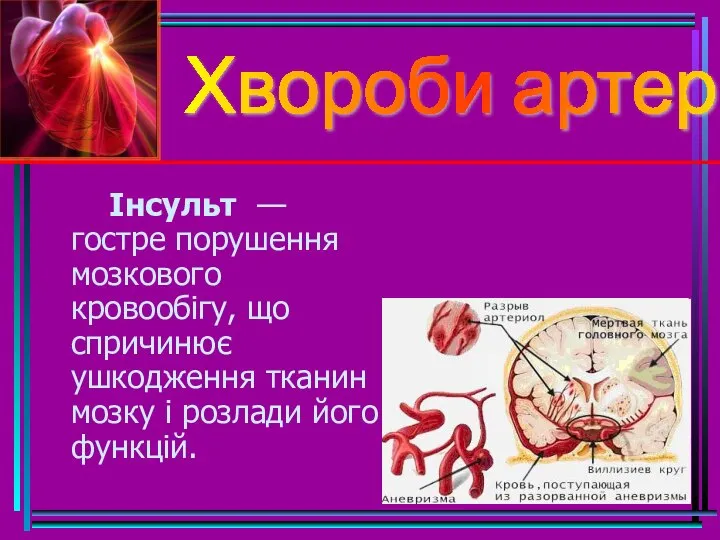 Хвороби артерій Інсульт — гостре порушення мозкового кровообігу, що спричинює ушкодження тканин