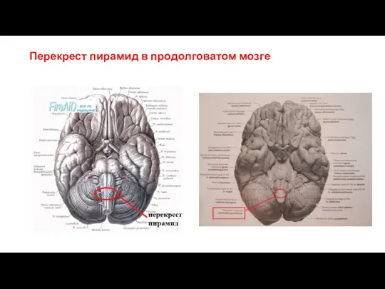 Перекрест пирамид в продолговатом мозге