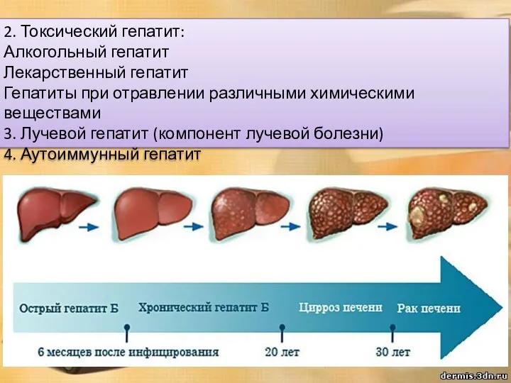 2. Токсический гепатит: Алкогольный гепатит Лекарственный гепатит Гепатиты при отравлении различными химическими