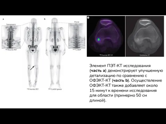 Элемент ПЭТ-КТ исследования (часть a) демонстрирует улучшенную детализацию по сравнению с ОФЭКТ-КТ