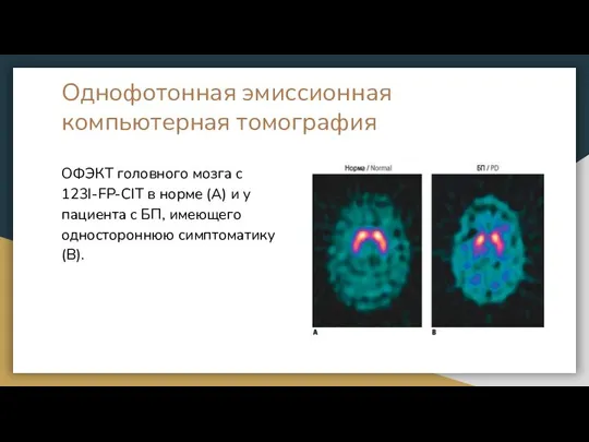 Однофотонная эмиссионная компьютерная томография ОФЭКТ головного мозга с 123I-FP-CIT в норме (А)