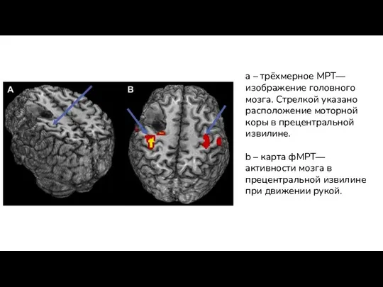 а – трёхмерное МРТ—изображение головного мозга. Стрелкой указано расположение моторной коры в