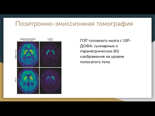Позитронно-эмиссионная томография ПЭТ головного мозга с 18F-ДОФА: суммарные и параметрические (Ki) изображения на уровне полосатого тела.