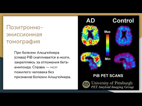 Позитронно-эмиссионная томография При болезни Альцгеймера (слева) PiB скапливается в мозге, закрепляясь за