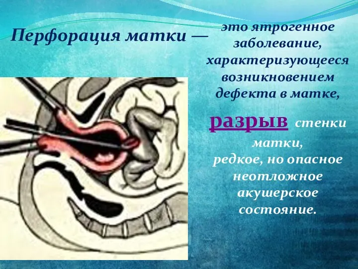 это ятрогенное заболевание, характеризующееся возникновением дефекта в матке, разрыв стенки матки, редкое,