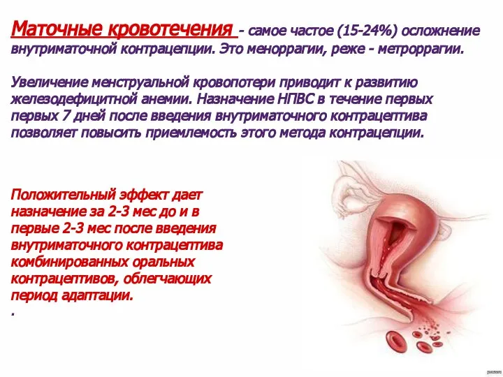 Маточные кровотечения - самое частое (15-24%) осложнение внутриматочной контрацепции. Это меноррагии, реже