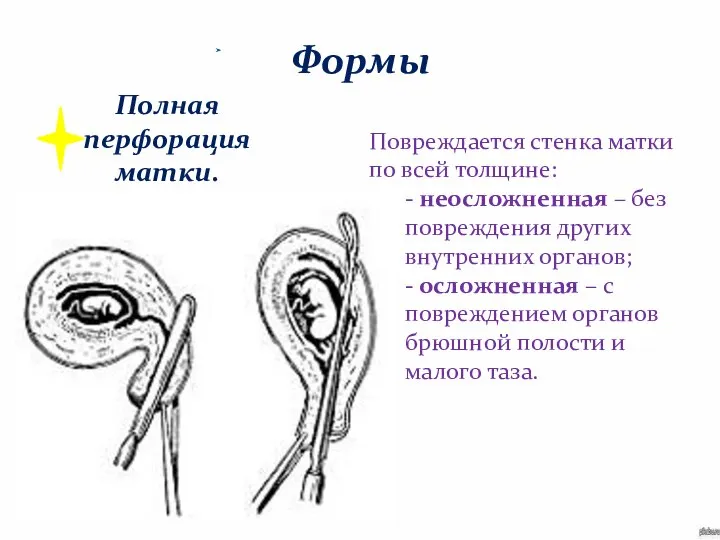 Формы Полная перфорация матки. Повреждается стенка матки по всей толщине: - неосложненная