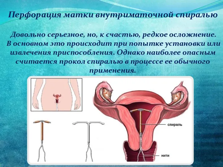 Перфорация матки внутриматочной спиралью Довольно серьезное, но, к счастью, редкое осложнение. В