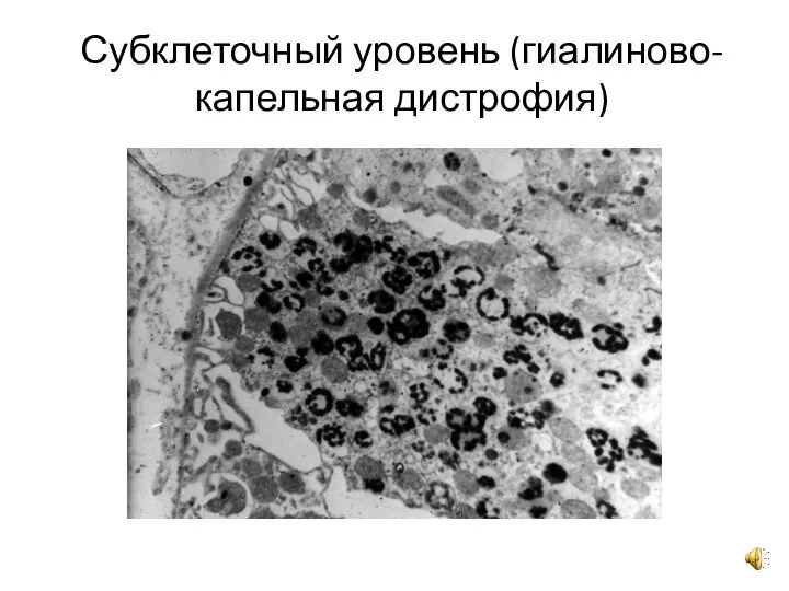 Субклеточный уровень (гиалиново-капельная дистрофия)