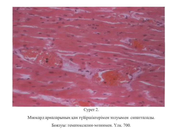 Сурет 2. Миокард арналарының қан түйіршіктерімен толуымен сипатталады. Боялуы: гематоксилин-эозинмен. Үлк. 700.