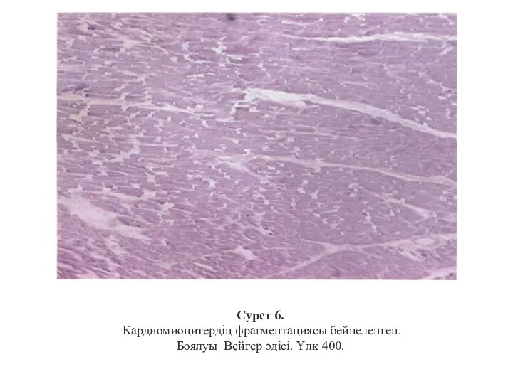 Сурет 6. Кардиомиоцитердің фрагментациясы бейнеленген. Боялуы Вейгер әдісі. Үлк 400.