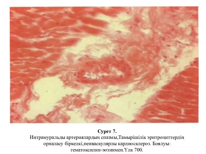 Сурет 7. Интрамуральды артериялардың спазмы,Тамырішілік эритроциттердің орналасу біркелкі,пеиваскулярлы кардиосклероз. Боялуы: гематоксилин-эозинмен.Үлк 700.