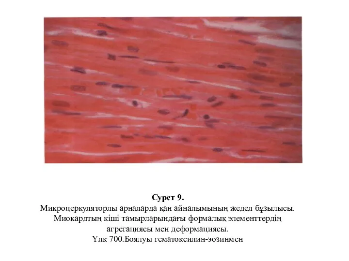 Сурет 9. Микроцеркуляторлы арналарда қан айналымының жедел бұзылысы. Миокардтың кіші тамырларындағы формалық