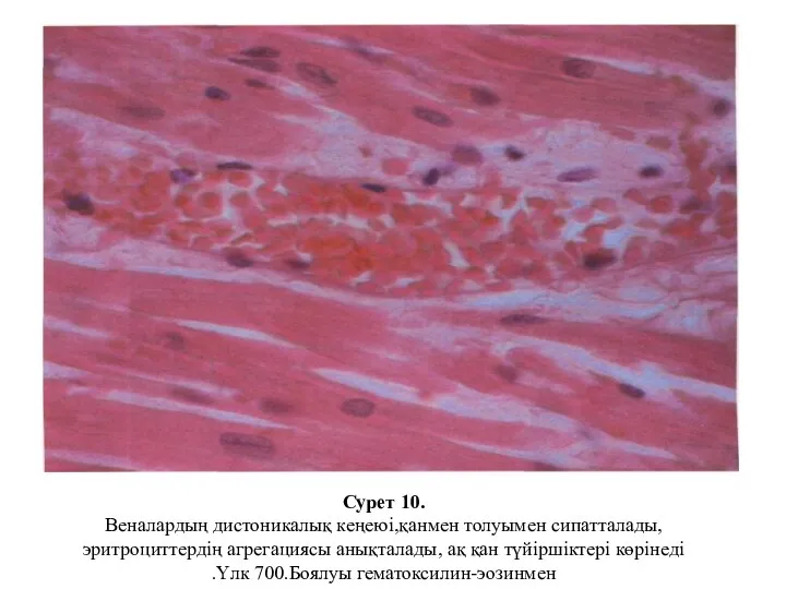 Сурет 10. Веналардың дистоникалық кеңеюі,қанмен толуымен сипатталады, эритроциттердің агрегациясы анықталады, ақ қан
