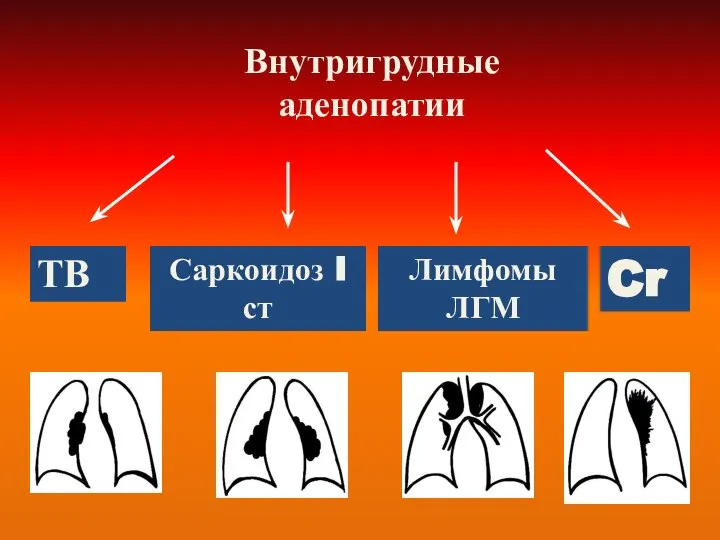 Внутригрудные аденопатии ТВ Саркоидоз I ст Лимфомы ЛГМ Cr