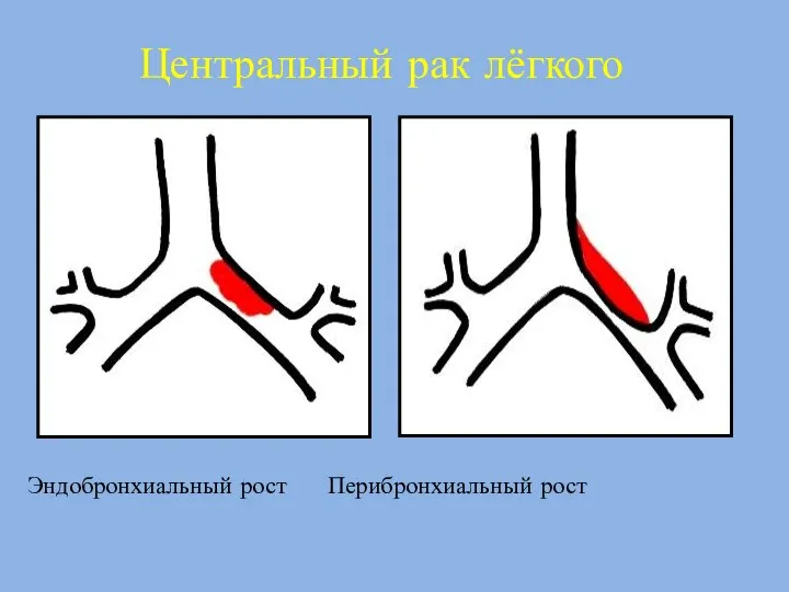 Центральный рак лёгкого Эндобронхиальный рост Перибронхиальный рост