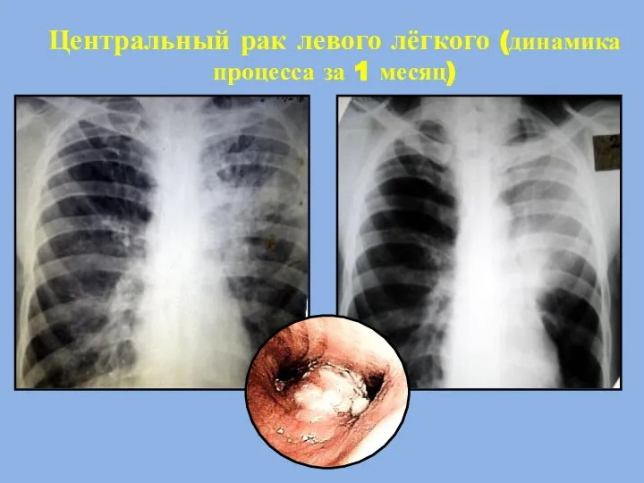 Центральный рак левого лёгкого (динамика процесса за 1 месяц)