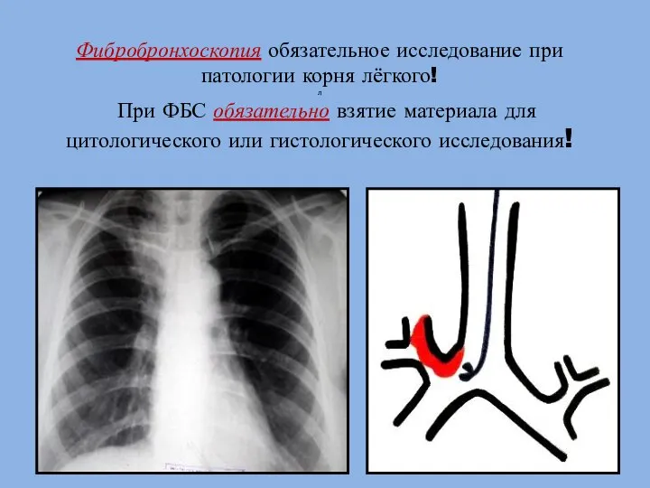 Фибробронхоскопия обязательное исследование при патологии корня лёгкого! л При ФБС обязательно взятие