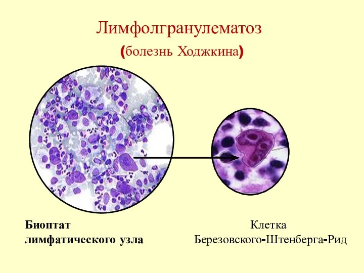 Лимфолгранулематоз (болезнь Ходжкина) Клетка Березовского-Штенберга-Рид Биоптат лимфатического узла