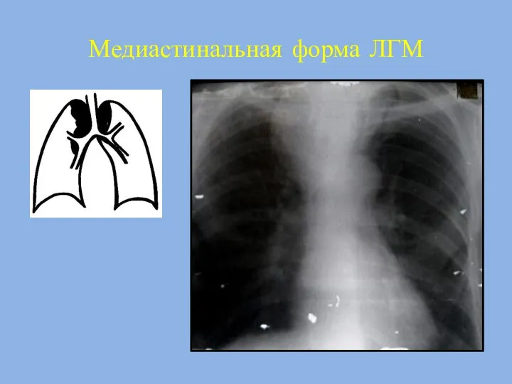 Медиастинальная форма ЛГМ