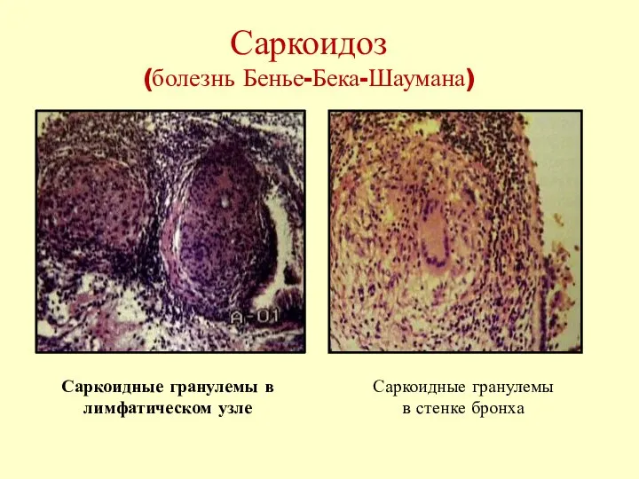 Саркоидоз (болезнь Бенье-Бека-Шаумана) Саркоидные гранулемы в лимфатическом узле Саркоидные гранулемы в стенке бронха