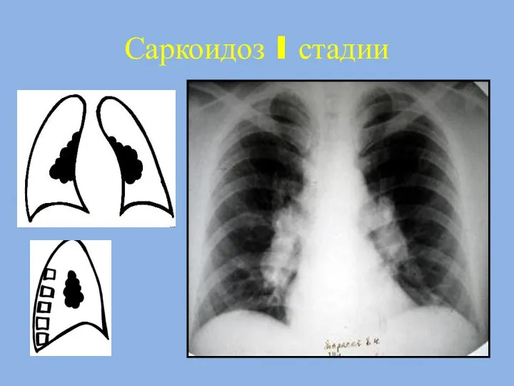 Саркоидоз I стадии