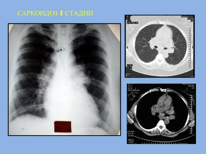 САРКОИДОЗ I СТАДИИ