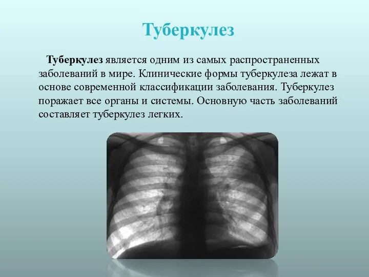 Туберкулез Туберкулез является одним из самых распространенных заболеваний в мире. Клинические формы