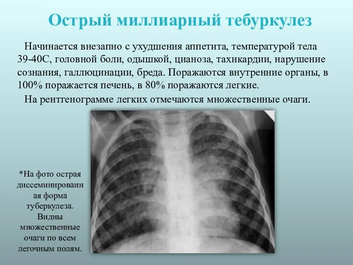 Острый миллиарный тебуркулез Начинается внезапно с ухудшения аппетита, температурой тела 39-40С, головной