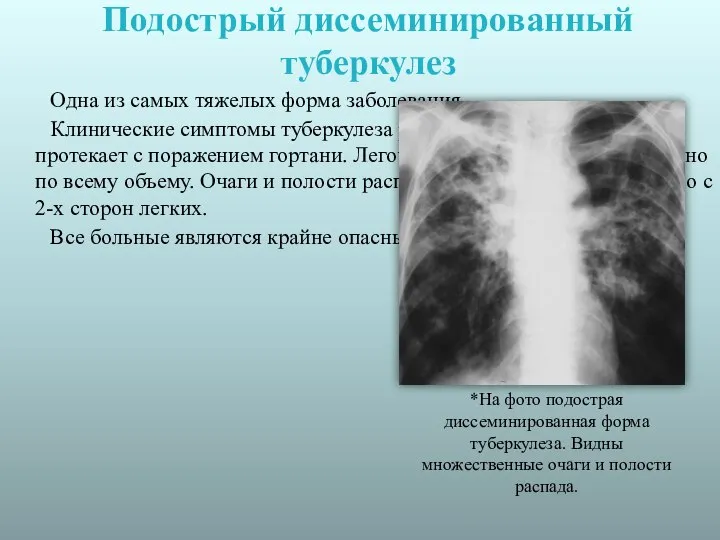 Подострый диссеминированный туберкулез Одна из самых тяжелых форма заболевания. Клинические симптомы туберкулеза