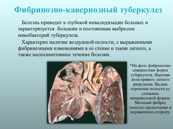 Фибринозно-кавернозный туберкулез Болезнь приводит к глубокой инвалидизации больных и характеризуется большим и