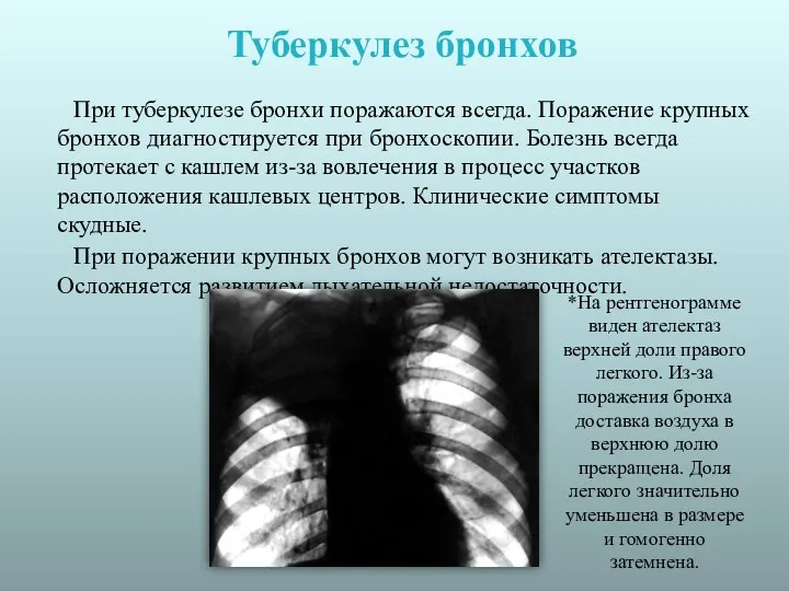 Туберкулез бронхов При туберкулезе бронхи поражаются всегда. Поражение крупных бронхов диагностируется при