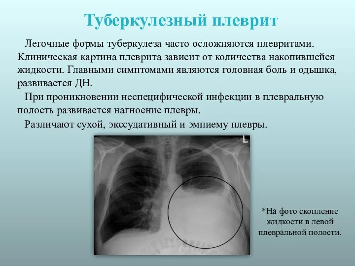 Туберкулезный плеврит Легочные формы туберкулеза часто осложняются плевритами. Клиническая картина плеврита зависит