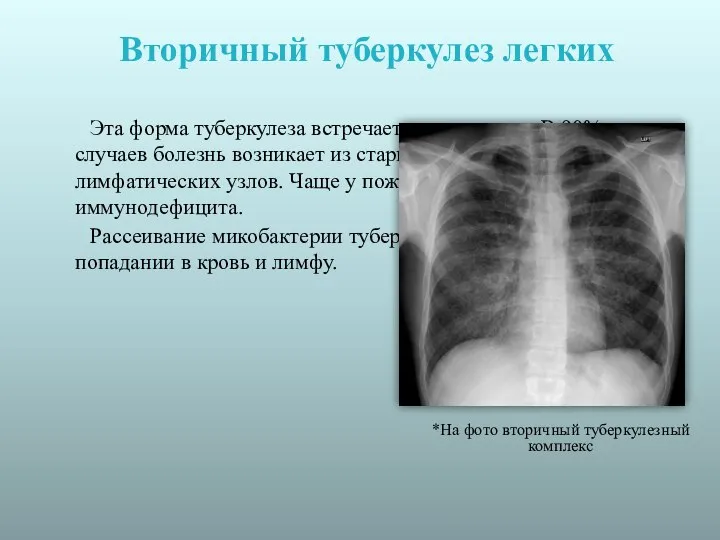 Вторичный туберкулез легких Эта форма туберкулеза встречается чаще всего. В 90% случаев