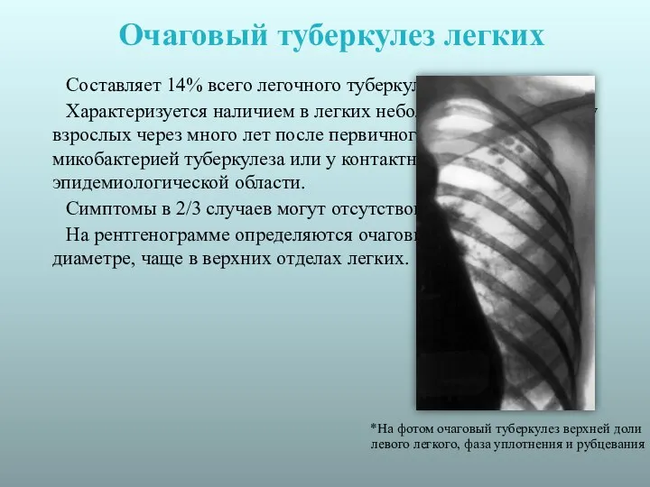 Очаговый туберкулез легких Составляет 14% всего легочного туберкулеза. Характеризуется наличием в легких