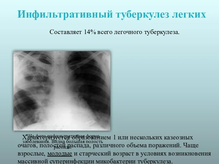 Инфильтративный туберкулез легких Составляет 14% всего легочного туберкулеза. Характеризуется образованием 1 или