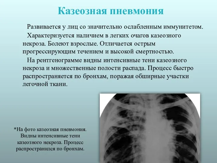 Казеозная пневмония Развивается у лиц со значительно ослабленным иммунитетом. Характеризуется наличием в