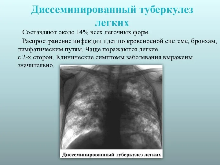 Диссеминированный туберкулез легких Составляют около 14% всех легочных форм. Распространение инфекции идет