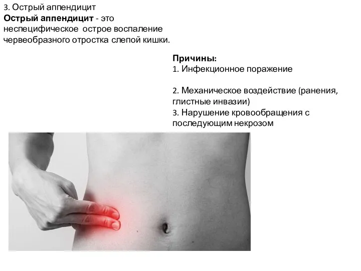 3. Острый аппендицит Острый аппендицит - это неспецифическое острое воспаление червеобразного отростка