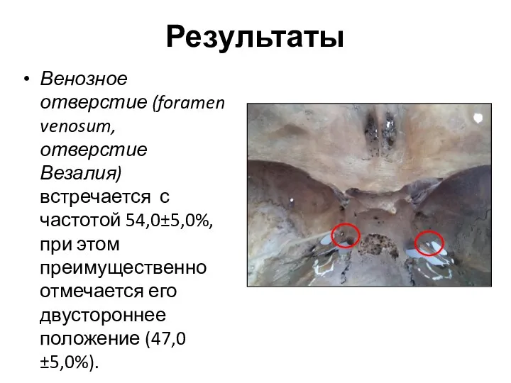 Результаты Венозное отверстие (foramen venosum, отверстие Везалия) встречается с частотой 54,0±5,0%, при