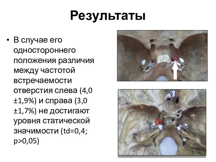 Результаты В случае его одностороннего положения различия между частотой встречаемости отверстия слева