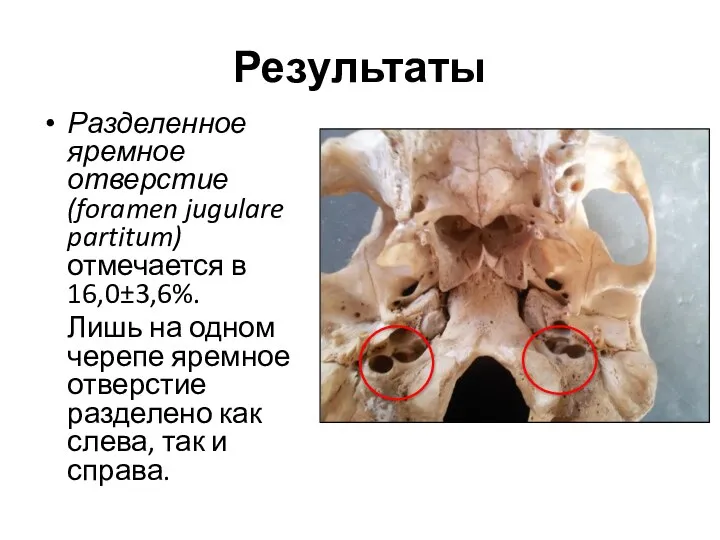 Результаты Разделенное яремное отверстие (foramen jugulare partitum) отмечается в 16,0±3,6%. Лишь на