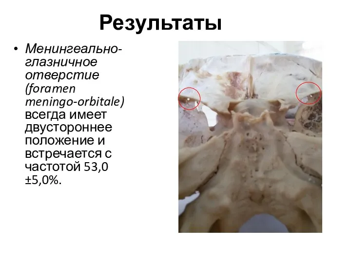 Результаты Менингеально-глазничное отверстие (foramen meningo-orbitale) всегда имеет двустороннее положение и встречается с частотой 53,0±5,0%.