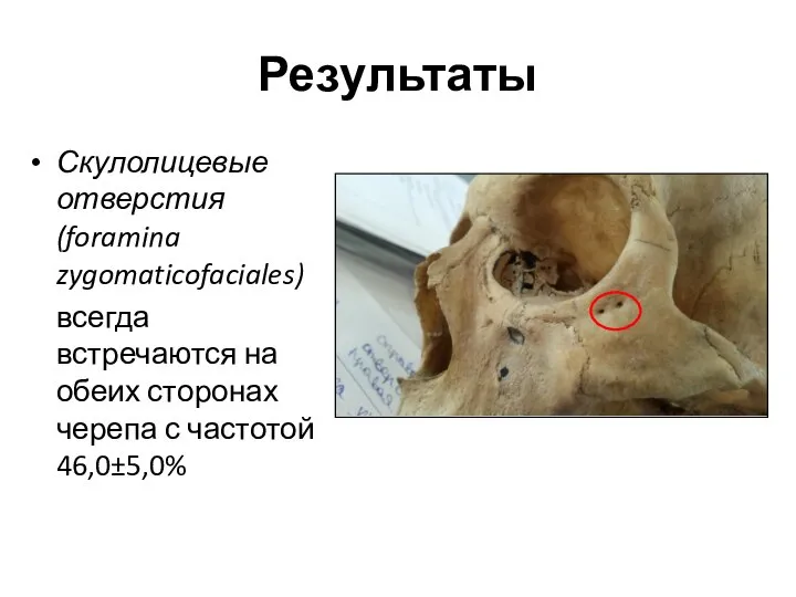 Результаты Скулолицевые отверстия (foramina zygomaticofaciales) всегда встречаются на обеих сторонах черепа с частотой 46,0±5,0%