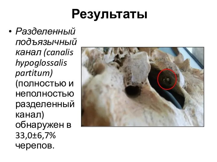 Результаты Разделенный подъязычный канал (canalis hypoglossalis partitum) (полностью и неполностью разделенный канал) обнаружен в 33,0±6,7% черепов.