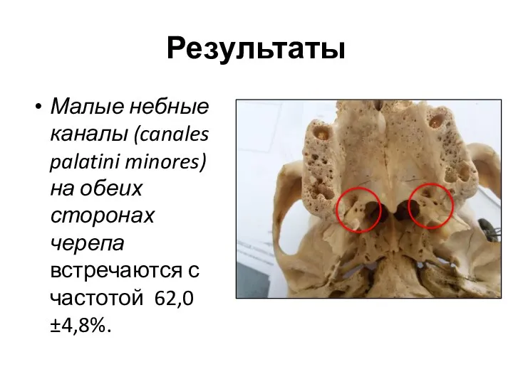 Результаты Малые небные каналы (canales palatini minores) на обеих сторонах черепа встречаются с частотой 62,0±4,8%.