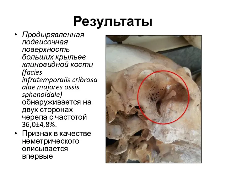 Результаты Продырявленная подвисочная поверхность больших крыльев клиновидной кости (facies infratemporalis cribrosa alae
